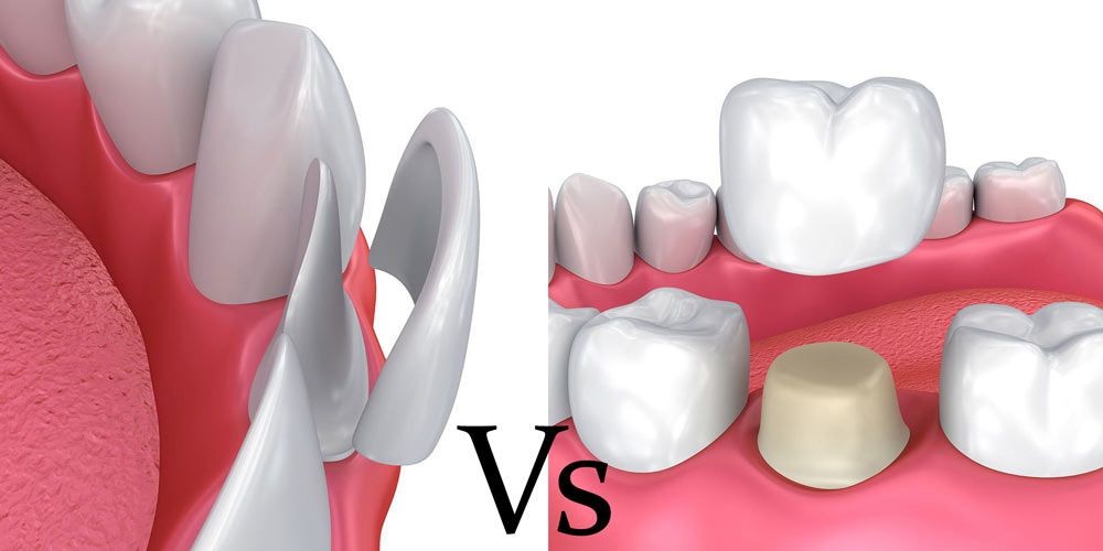coroana vs fateta dentara